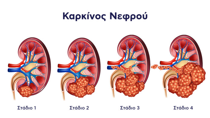 Καρκίνος Νεφρού: Συμπτώματα και Σύγχρονη Αντιμετώπιση – Όσα Πρέπει να Γνωρίζετε